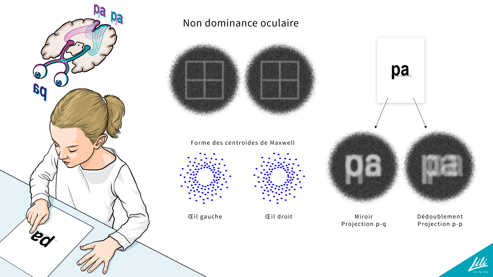 Illustration – non dominance oculaire